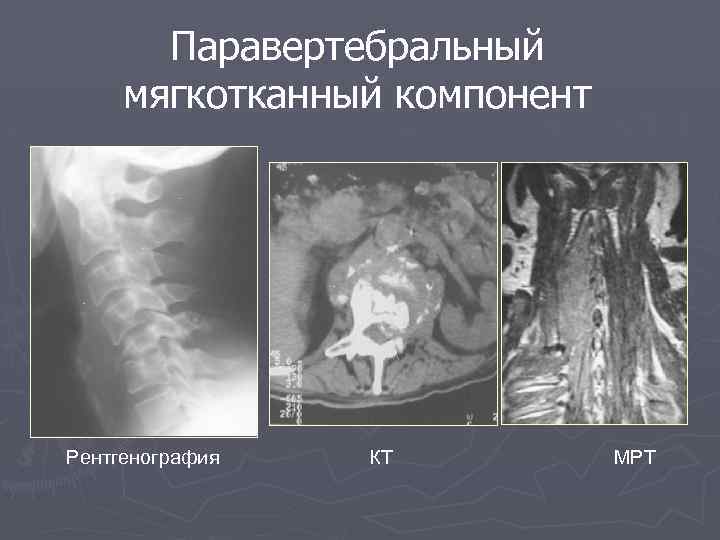 Паравертебральный мягкотканный компонент Рентгенография КТ МРТ 