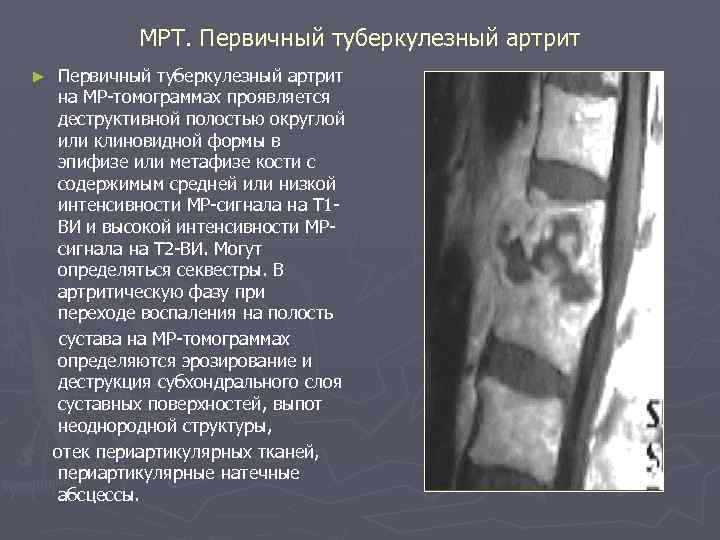 МРТ. Первичный туберкулезный артрит ► Первичный туберкулезный артрит на МР-томограммах проявляется деструктивной полостью округлой