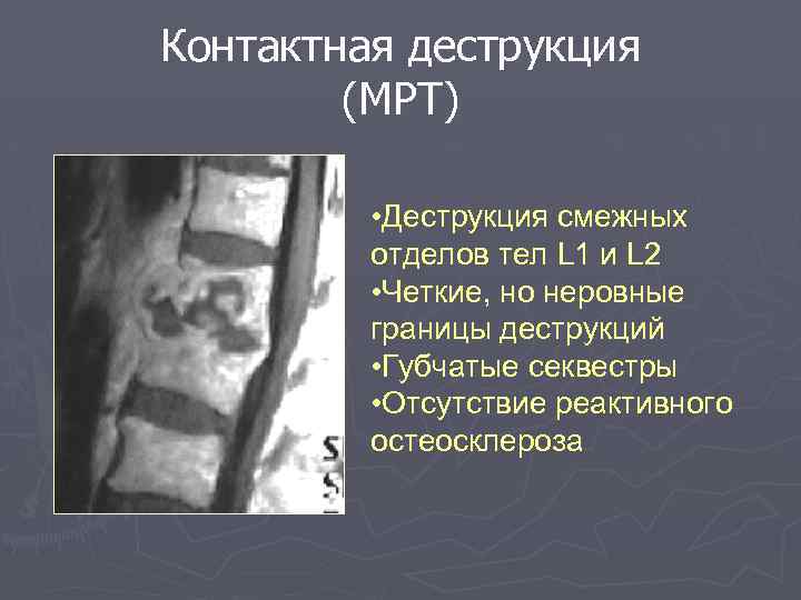 Контактная деструкция (МРТ) • Деструкция смежных отделов тел L 1 и L 2 •