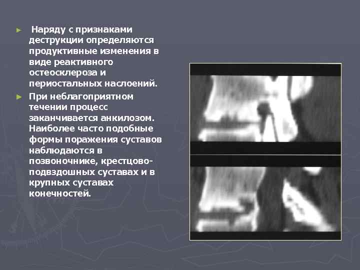 Наряду с признаками деструкции определяются продуктивные изменения в виде реактивного остеосклероза и периостальных наслоений.