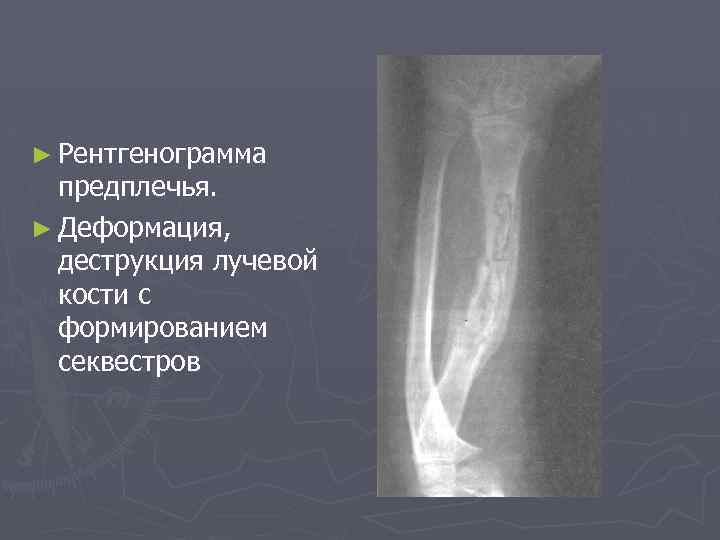 ► Рентгенограмма предплечья. ► Деформация, деструкция лучевой кости с формированием секвестров 