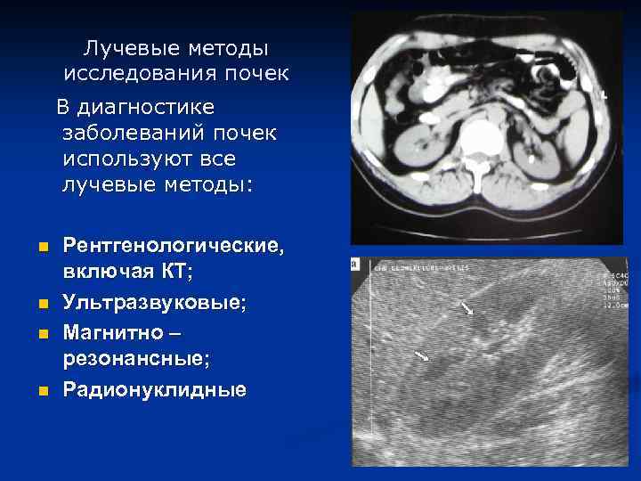 Лучевая диагностика почек презентация