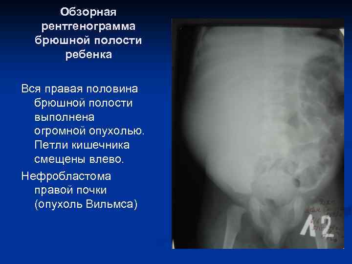 Обзорная рентгенограмма брюшной полости ребенка Вся правая половина брюшной полости выполнена огромной опухолью. Петли