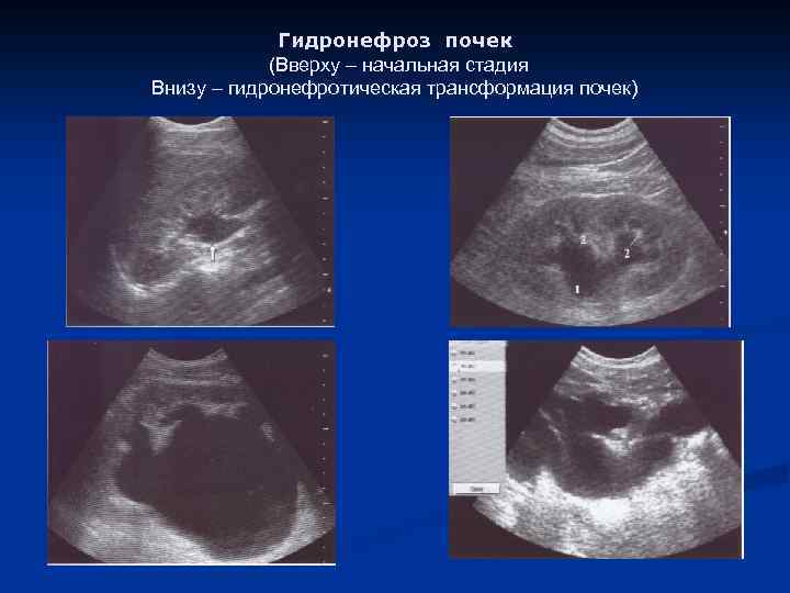 Гидронефроз почек (Вверху – начальная стадия Внизу – гидронефротическая трансформация почек) 