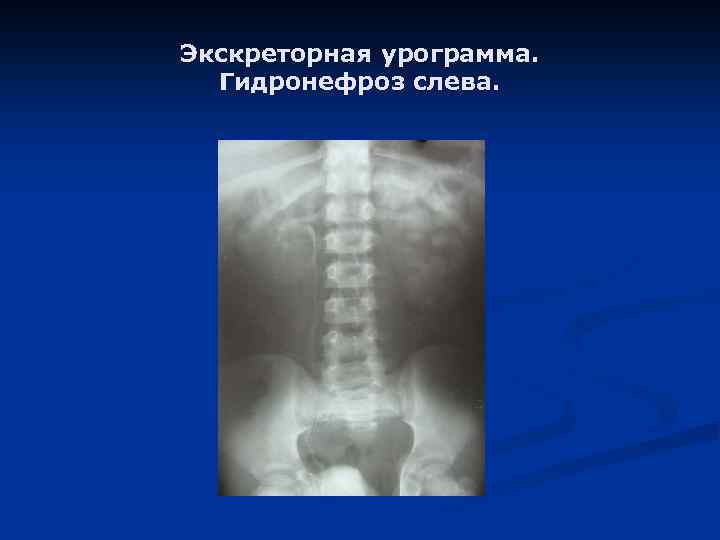 Экскреторная урограмма. Гидронефроз слева. 