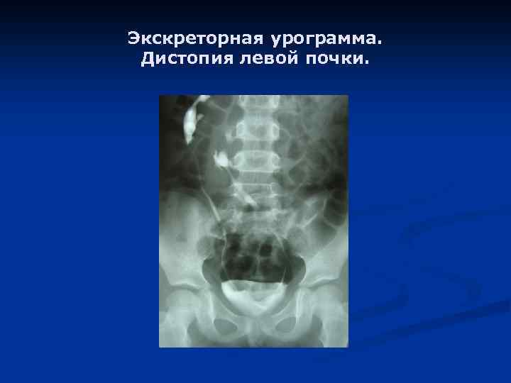 Экскреторная урограмма. Дистопия левой почки. 