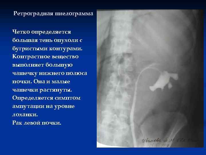 Ретроградная пиелограмма Четко определяется большая тень опухоли с бугристыми контурами. Контрастное вещество выполняет большую