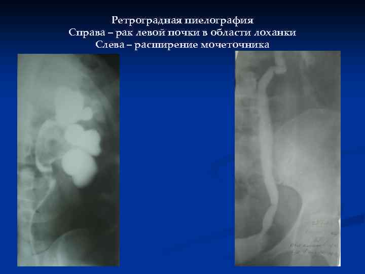 Ретроградная пиелография Справа – рак левой почки в области лоханки Слева – расширение мочеточника