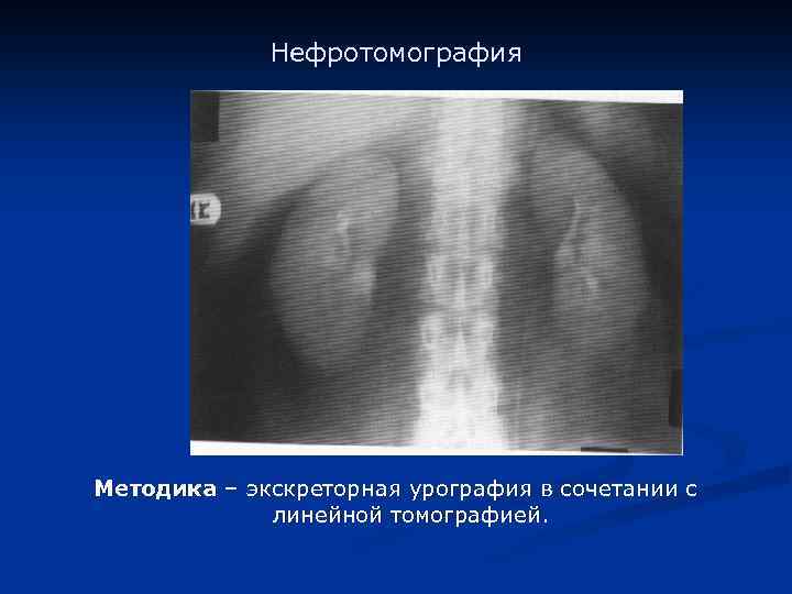 Нефротомография Методика – экскреторная урография в сочетании с линейной томографией. 