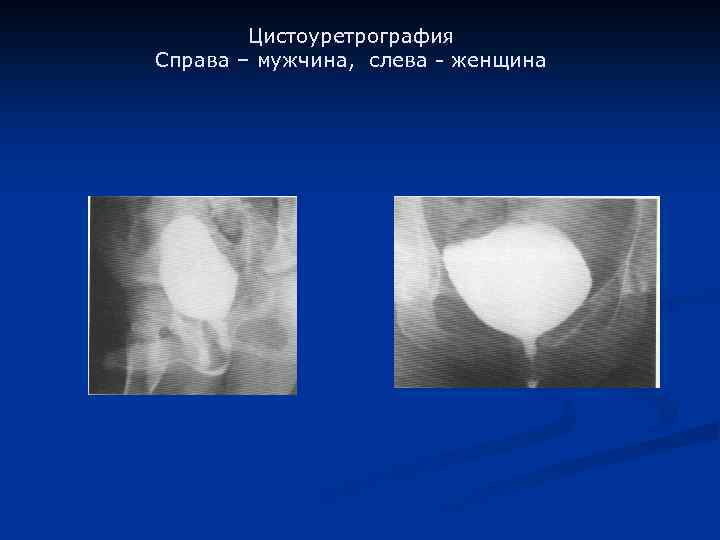Цистоуретрография Справа – мужчина, слева - женщина 