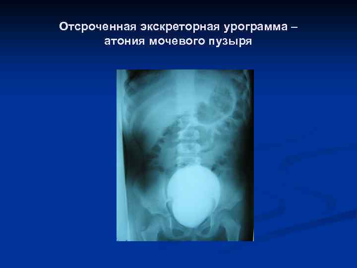 Отсроченная экскреторная урограмма – атония мочевого пузыря 