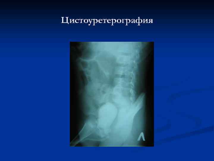 Цистоуретерография 
