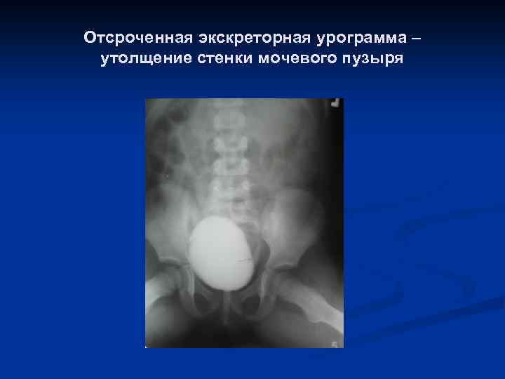 Отсроченная экскреторная урограмма – утолщение стенки мочевого пузыря 