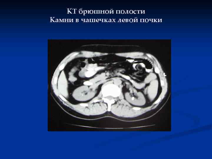 КТ брюшной полости Камни в чашечках левой почки 