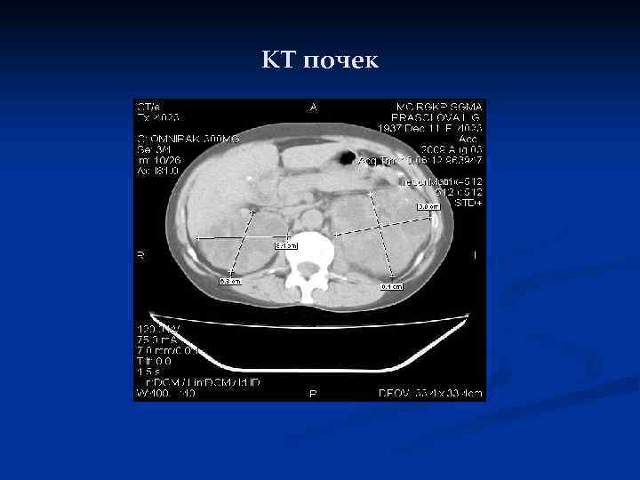 КТ почек 