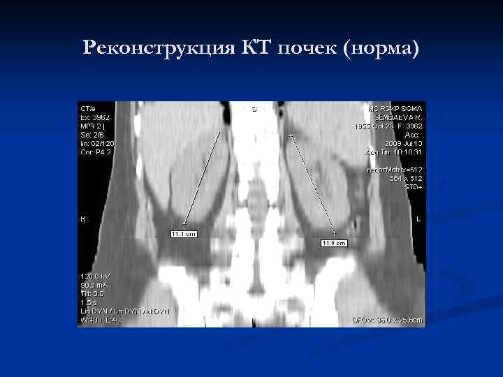 Реконструкция КТ почек (норма) 