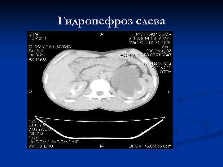 Гидронефроз слева 