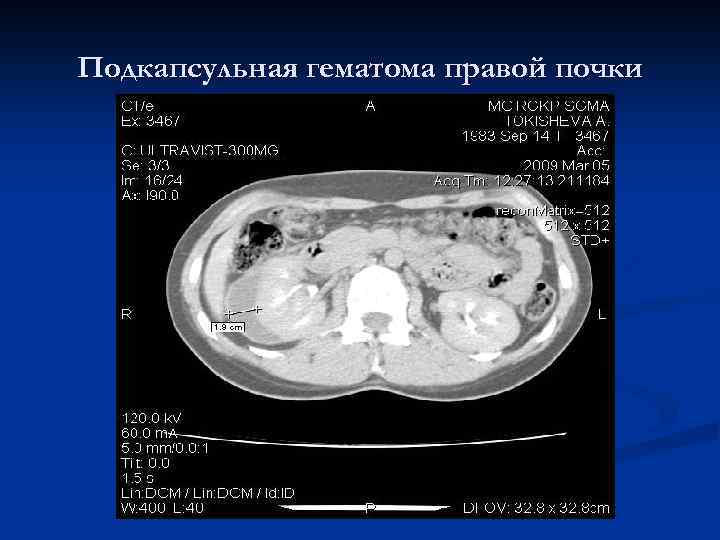 Подкапсульная гематома правой почки 