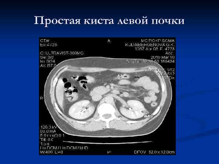 Простая киста левой почки 