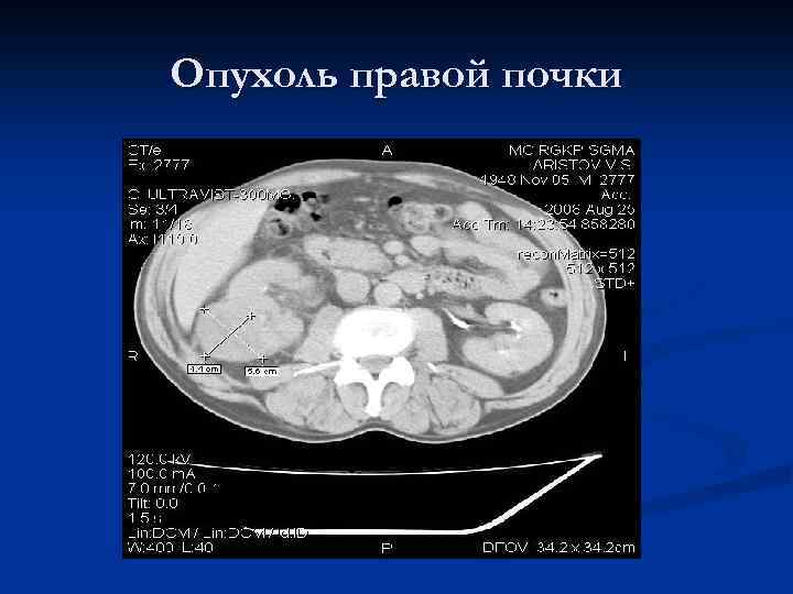 Опухоль правой почки 