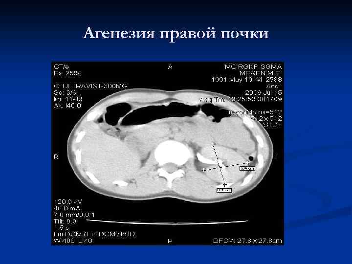 Агенезия правой почки 