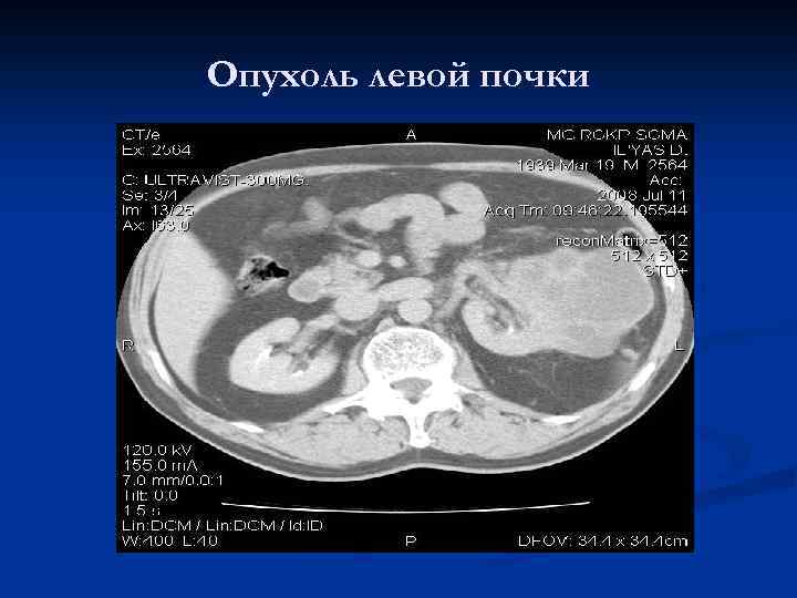 Опухоль левой почки 