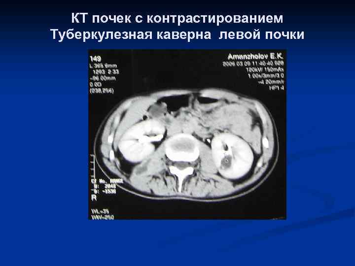 КТ почек с контрастированием Туберкулезная каверна левой почки 