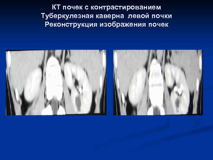 КТ почек с контрастированием Туберкулезная каверна левой почки Реконструкция изображения почек 