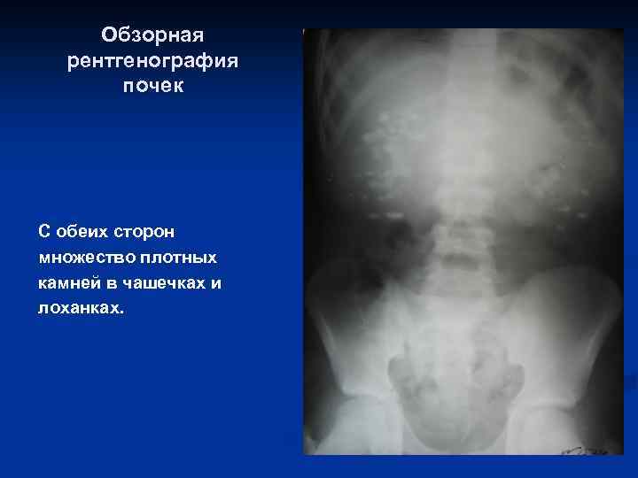 Обзорная рентгенография почек С обеих сторон множество плотных камней в чашечках и лоханках. 