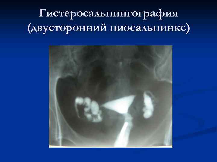Гистеросальпингография (двусторонний пиосальпинкс) 
