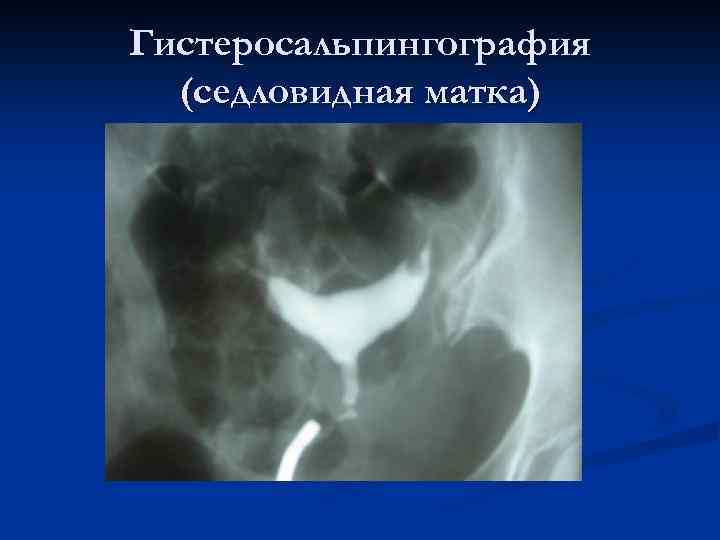 Гистеросальпингография (седловидная матка) 