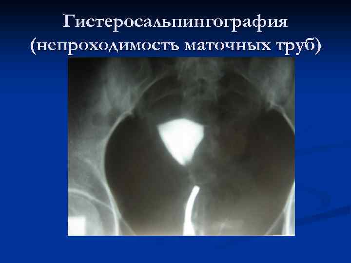 Гистеросальпингография (непроходимость маточных труб) 