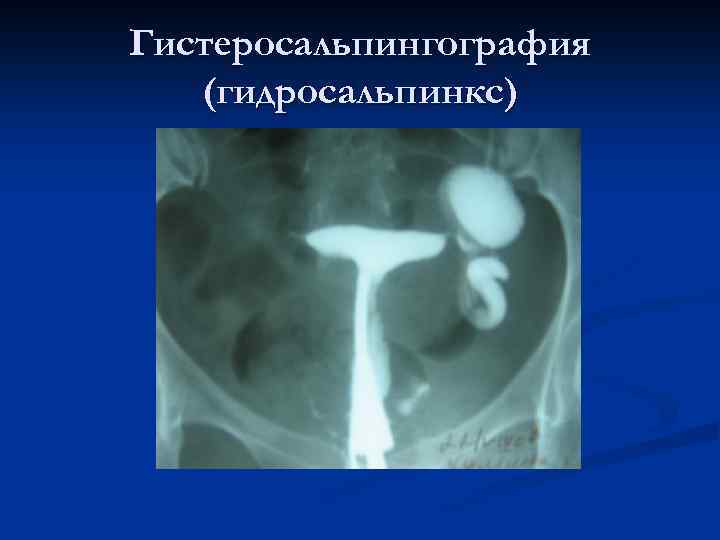 Гистеросальпингография (гидросальпинкс) 