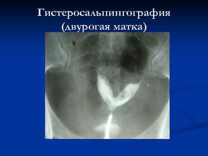 Гистеросальпингография (двурогая матка) 