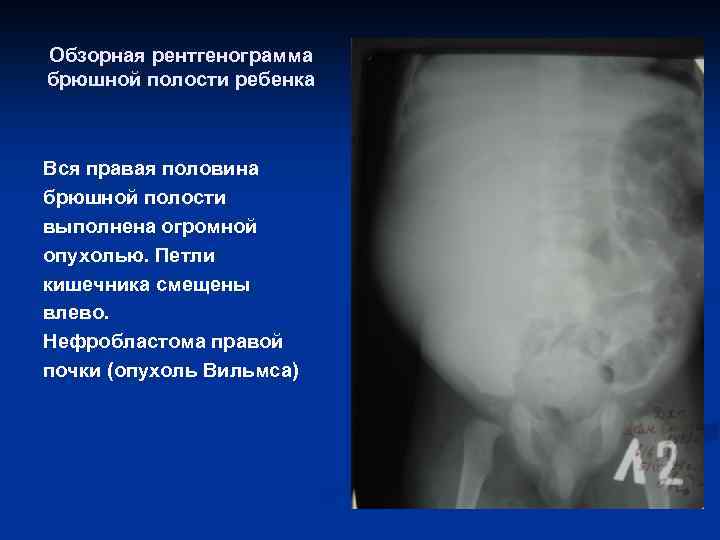 Обзорная рентгенограмма брюшной полости ребенка Вся правая половина брюшной полости выполнена огромной опухолью. Петли