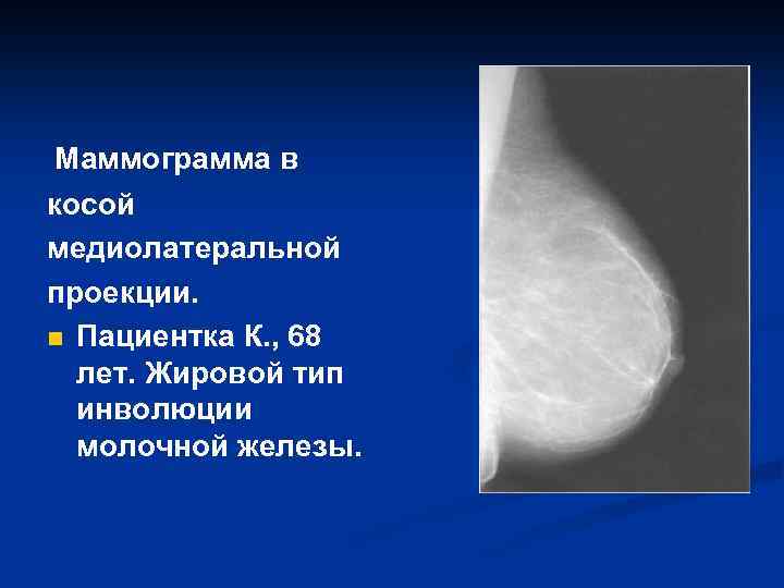 Маммограмма в косой медиолатеральной проекции. n Пациентка К. , 68 лет. Жировой тип инволюции
