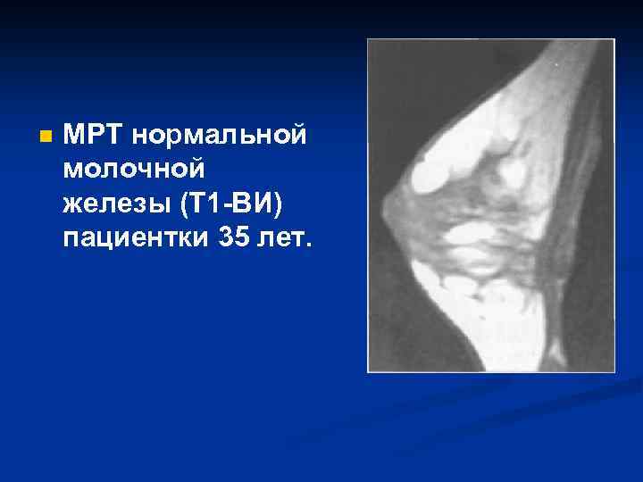 n МРТ нормальной молочной железы (Т 1 -ВИ) пациентки 35 лет. 