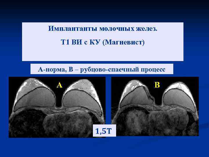 Имплантанты молочных желез. Т 1 ВИ с КУ (Магневист) А-норма, В – рубцово-спаечный процесс