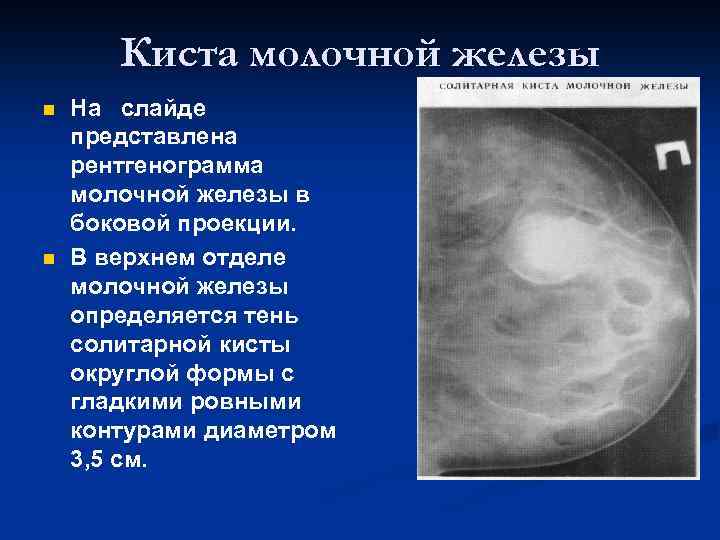 Киста молочной железы n n На слайде представлена рентгенограмма молочной железы в боковой проекции.