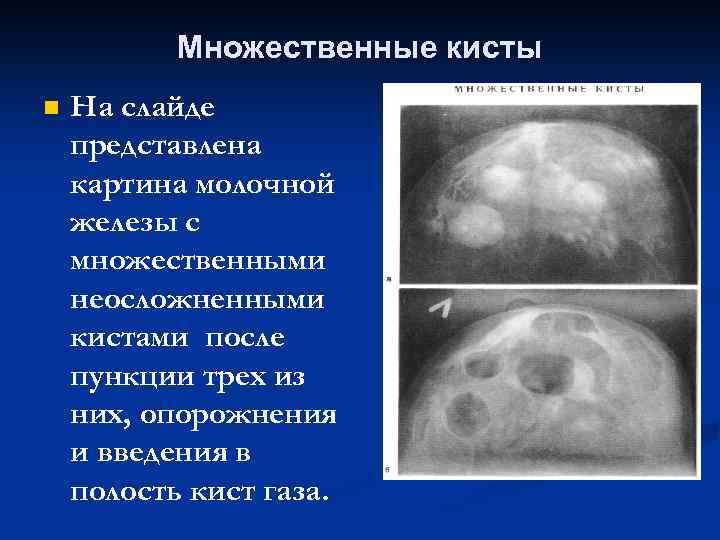 Множественные кисты n На слайде представлена картина молочной железы с множественными неосложненными кистами после