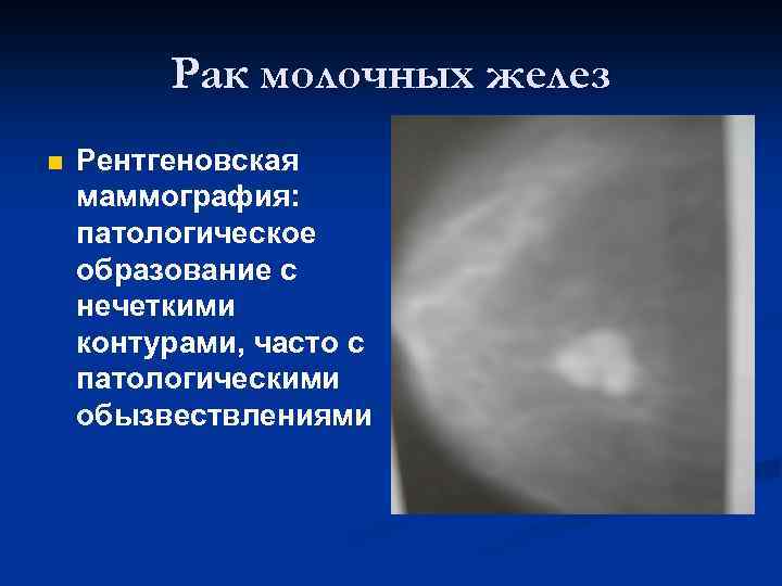 Рак молочных желез n Рентгеновская маммография: патологическое образование с нечеткими контурами, часто с патологическими