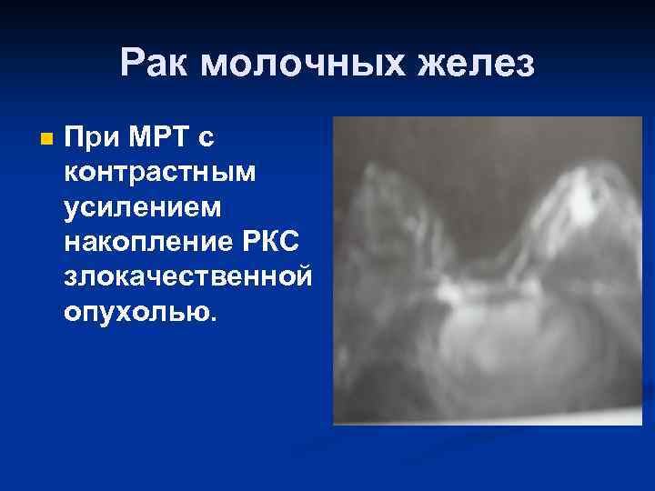 Рак молочных желез n При МРТ с контрастным усилением накопление РКС злокачественной опухолью. 