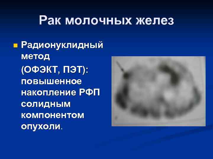 Рак молочных желез n Радионуклидный метод (ОФЭКТ, ПЭТ): повышенное накопление РФП солидным компонентом опухоли.