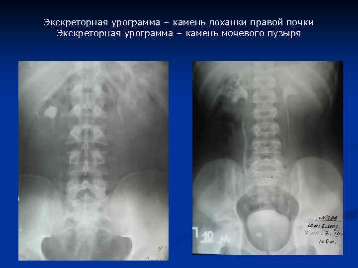 Экскреторная урограмма – камень лоханки правой почки Экскреторная урограмма – камень мочевого пузыря 