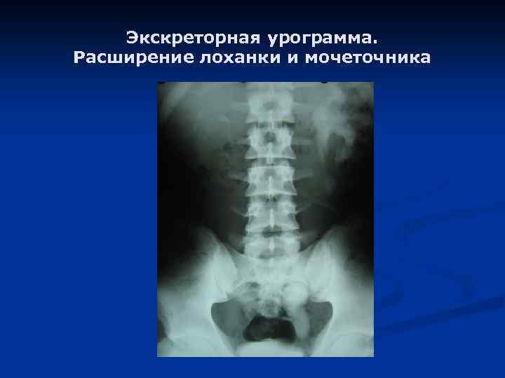 Экскреторная урограмма. Расширение лоханки и мочеточника 