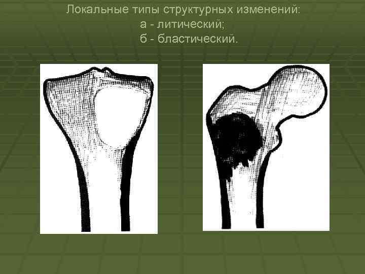 Локальные типы структурных изменений: а литический; б бластический. 