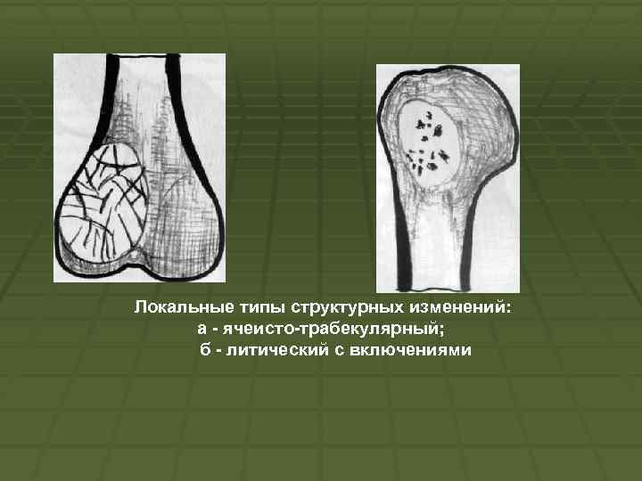 Локальные типы структурных изменений: а ячеисто трабекулярный; б литический с включениями 