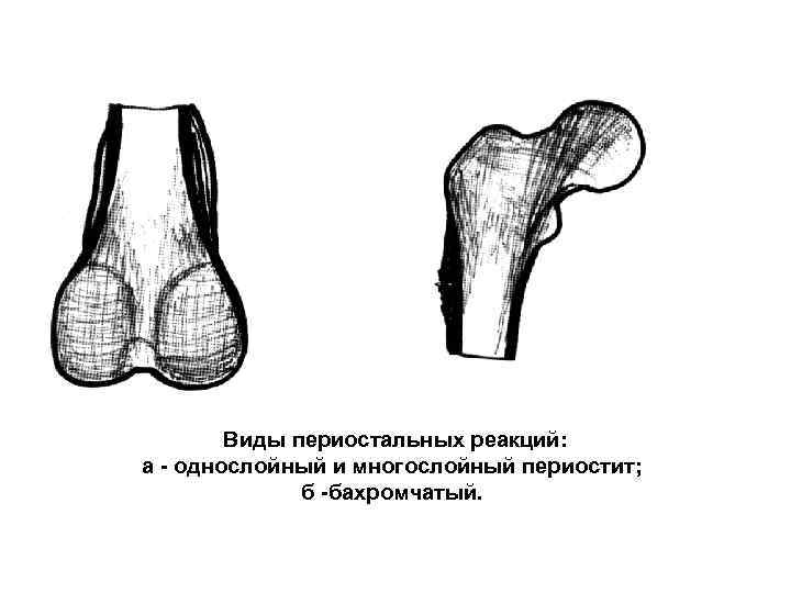Виды периостальных реакций: а однослойный и многослойный периостит; б бахромчатый. 