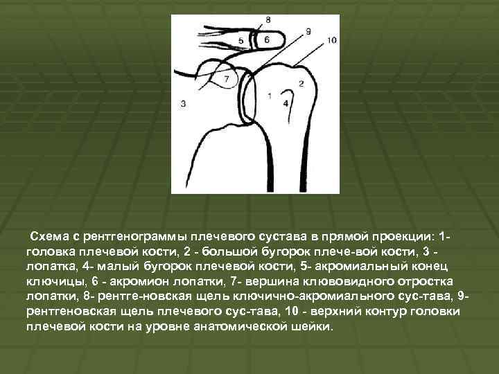 Схема с рентгенограммы плечевого сустава в прямой проекции: 1 головка плечевой кости, 2 большой
