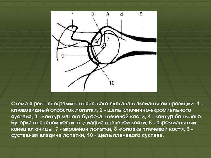 Схема с рентгенограммы плече вого сустава в аксиальной проекции: 1 клювовидный отросток лопатки, 2